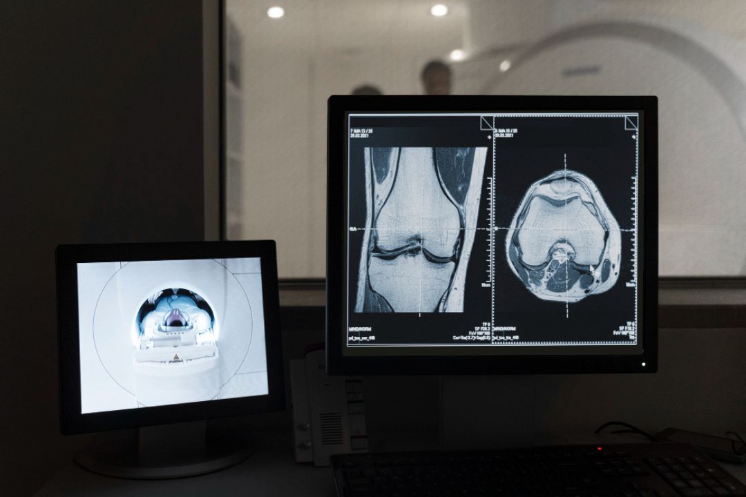 ct scan fracture detection speed